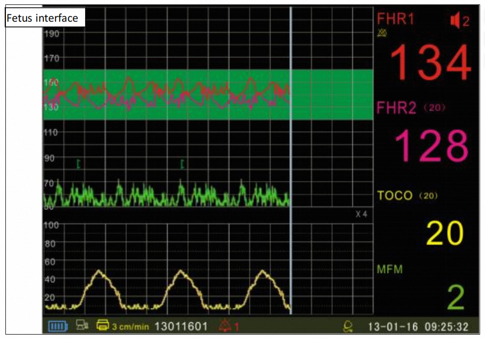 Portable CTG Fetal Monitor Machine with 12.1 manufacture