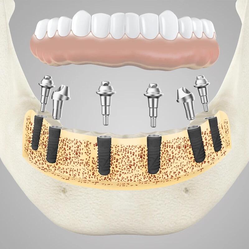 dental implant titanium