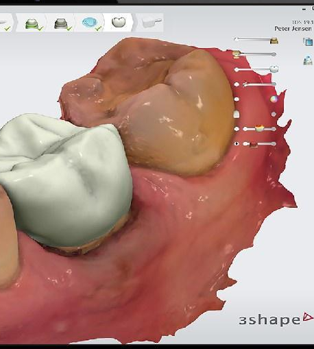 Empowering Dental Clinicians with 3Shape's Implant Studio