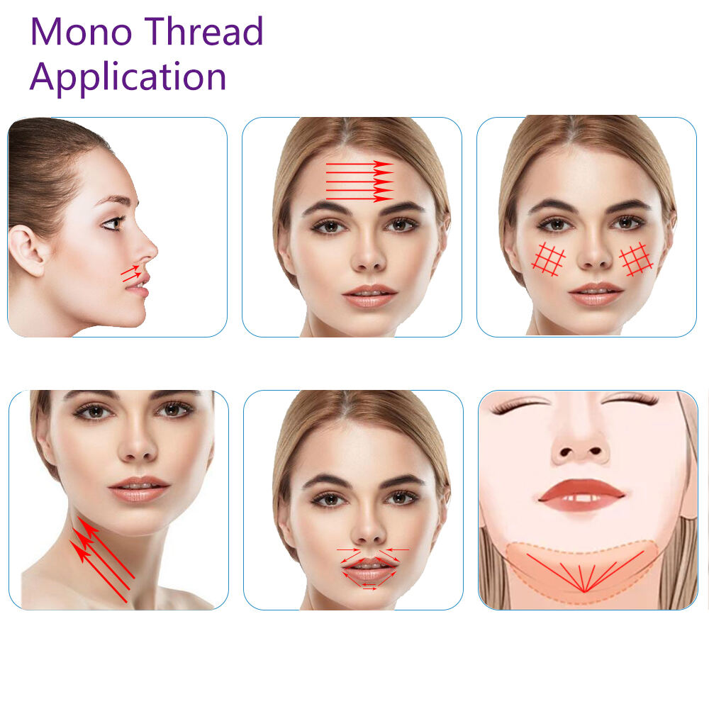 Plastic Surgery Face Lifting Thread 26g 38mm 60mm Pdo Pcl Wpdo Double Mono Threads With Ce Certificate manufacture