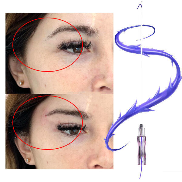 Inovacija Fox Eye Thread Lift