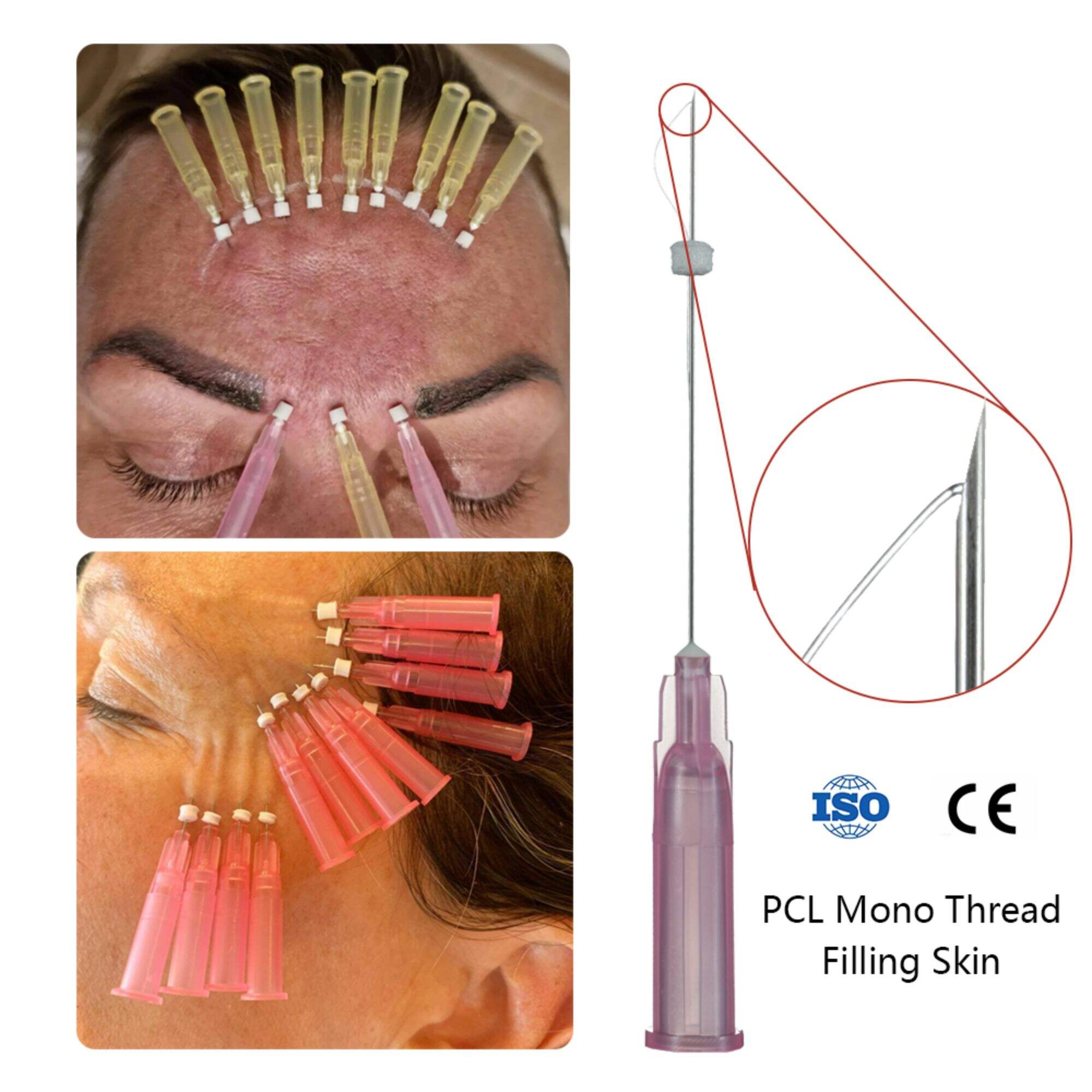 Ce Korea Sharp Double Mono Hilo Screw Cog Nose Fox Eye Pcl Pdo Wires Lifting Plla Face Filling 30g 38mm Mono Thread