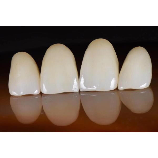 How Can Dental Glass Ceramics Improve Patient Satisfaction?