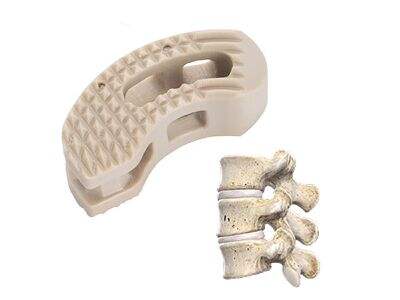 Cervical Cages in Revision Spine Surgery