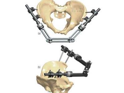 How to Select Reliable Ortho Instrument Suppliers