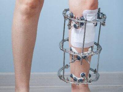 How to Choose the Right Ilizarov External Fixator System for Hospitals