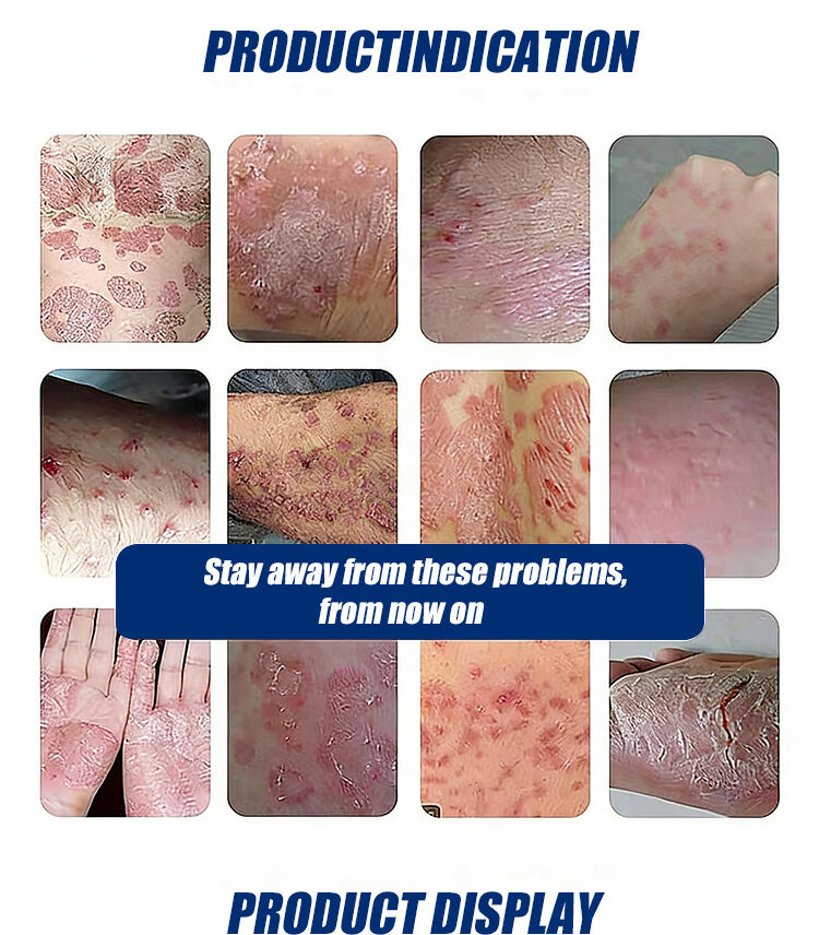 Caoshifu 50g Herbal Skin Care Ointment for Dermatitis Eczema Anti-itch Cream Urticaria Desquamation Natural Formula factory