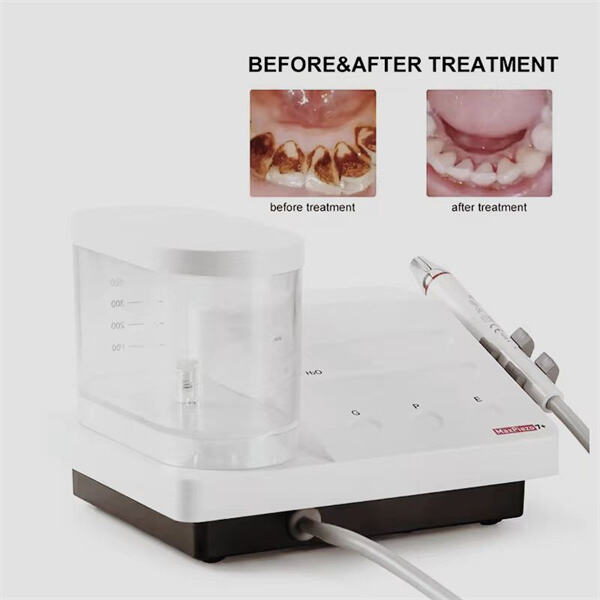 Advantages of Piezo Ultrasonic Scalers over Traditional Scaling Techniques