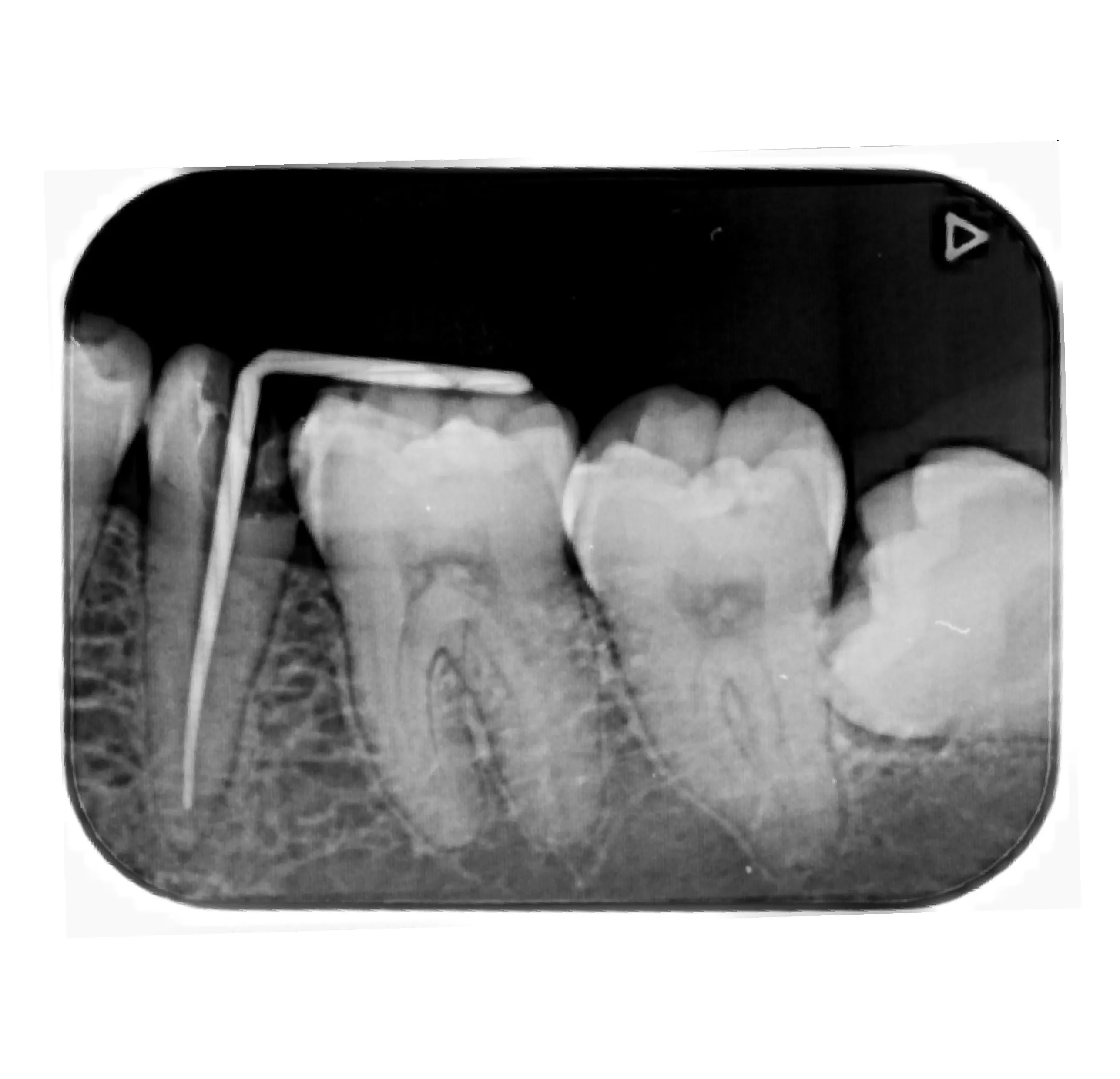 Pembuatan SENSOR INTRA-ORAL DIGITAL