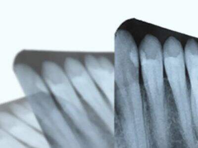 5 beneficios principales de usar una máquina de rayos X portátil en clínicas