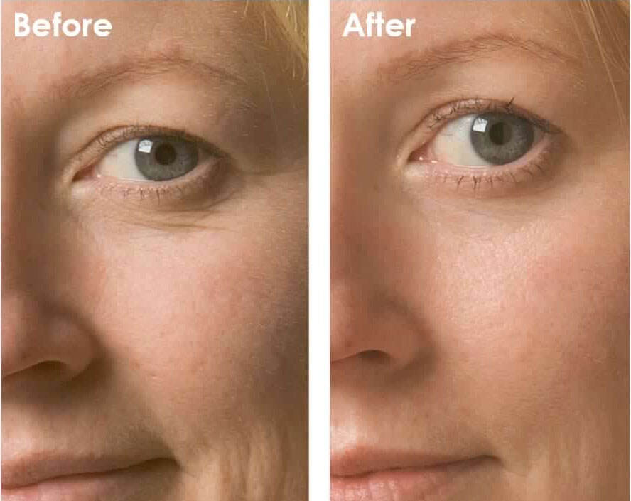 hyperoxic environments (90% or more oxygen) for 2 hours helped reduce the level of wrinkle formation and epidermal thickness