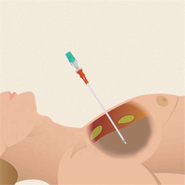 Melhorando os resultados dos pacientes por meio de descompressão precisa