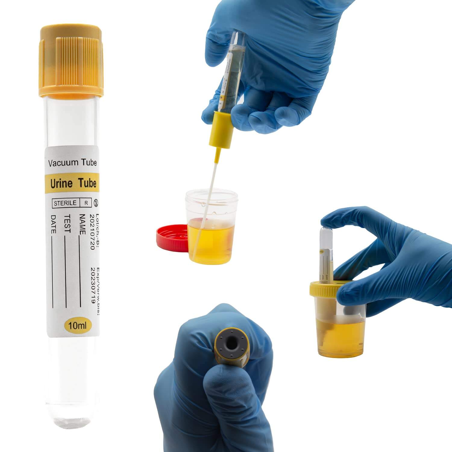 Why is a vacuum urine container essential for accurate urine tests?