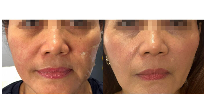 Terminal Age HIFU: Before & After Skin Rejuvenation