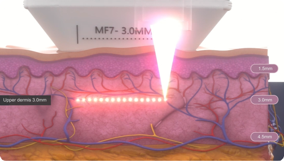 terminal age hlfu machine351-4