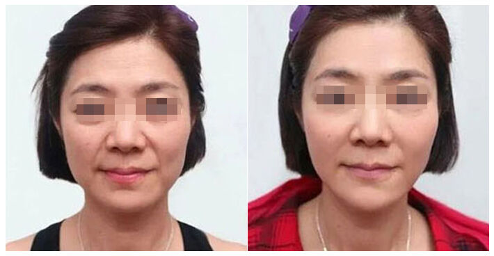 Transform Your Look with Terminal Age HIFU: Before and After