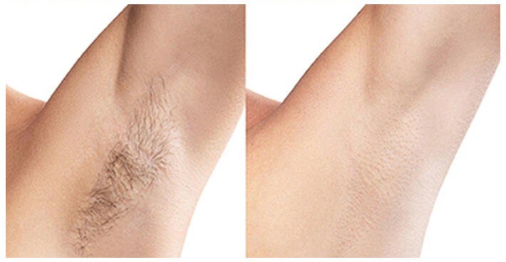 Underarm Hair Removal – Smooth, Confident Results