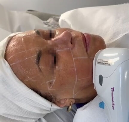 SMAS-réteg felfeszítése terminális korban alkalmazott HIFU-val – klinikai alkalmazás