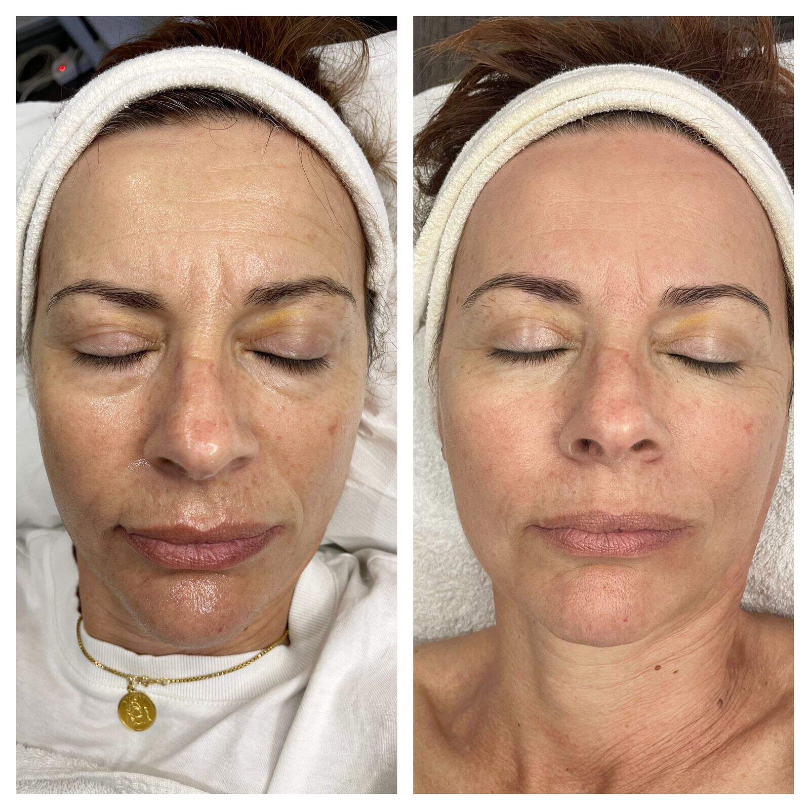 dedicated to stretch marks, pigmentation changes, skin resurfacing