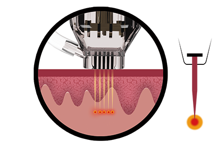 Insulated Needle Technology