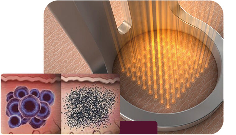 Precise Pigment Fragmentation for Efficient and Safe Skin Brightening