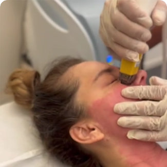 rf microneedle fractional machine482-12