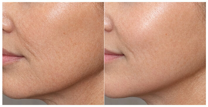 Visible Improvement After Gold Microneedling Treatment