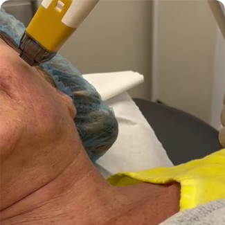 rf microneedle fractional machine482-15