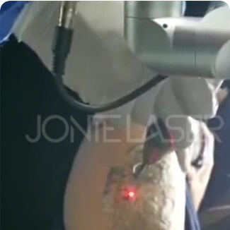 q switch nd yag laser615-9