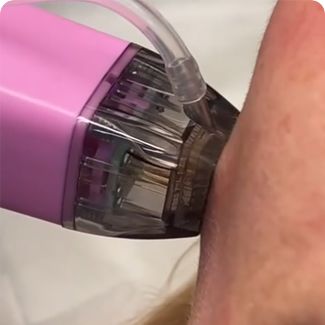 rf microneedle fractional machine482-13