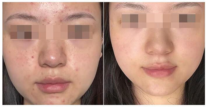 Gold Microneedling Results: From Problematic to Perfect Skin