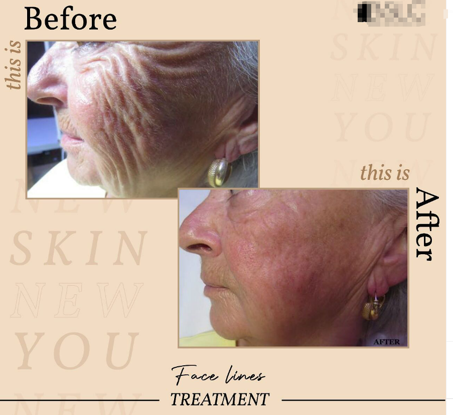 dual-frequency bipolar gold RF microneedling Treatment