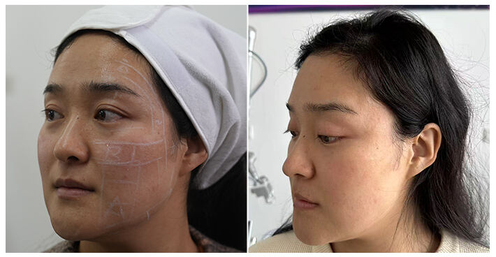 Noticeable Skin Lifting and Tightening with Terminal Age HIFU