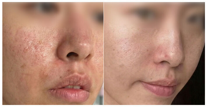 Transform Your Skin with Gold Microneedling: Before & After