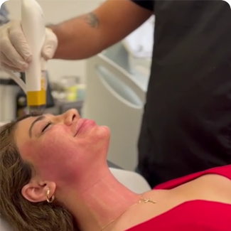 rf microneedle fractional machine482-14