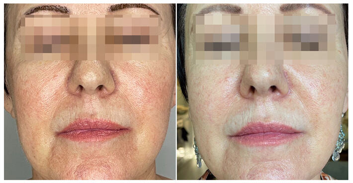 CO2 Fractional Laser Clinical Before & After