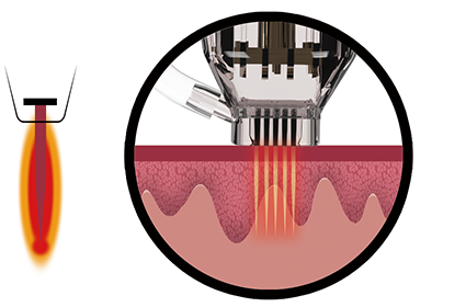 Non-Insulated Needle Technology