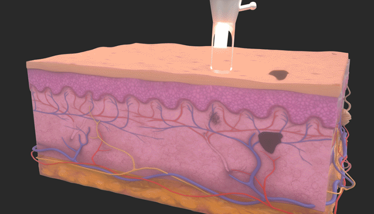 A Q-switched laser system operates through: