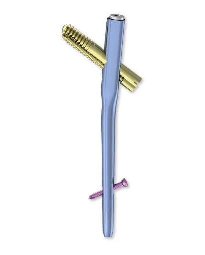 Top 10 Humerus Interlocking Nails for Proximal Humerus Fractures