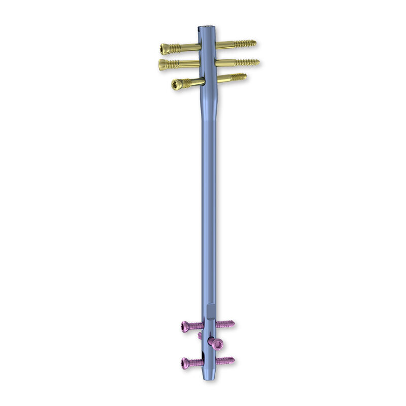 Customizable Implant for Various Fracture Patterns