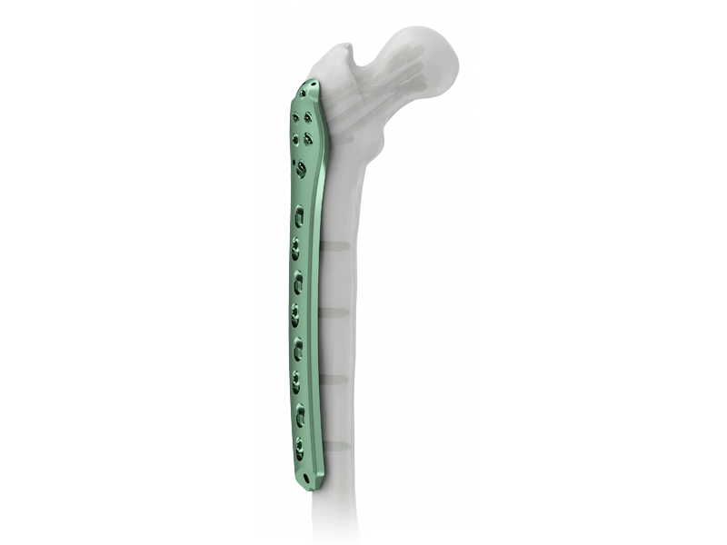 Versatility for Various Anatomies and Fractures