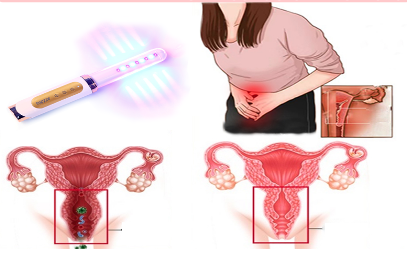 How Laser Gynecological Therapy Can Transform Women's Health