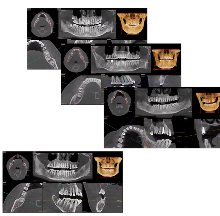 3D Dental Panoramic Xray Machine