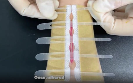 Instruksies vir die gebruik van wondsluitingsapparaat