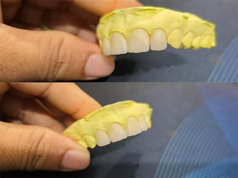 Zirconia veneer, made of 4D X ML zirconia disc.jpg