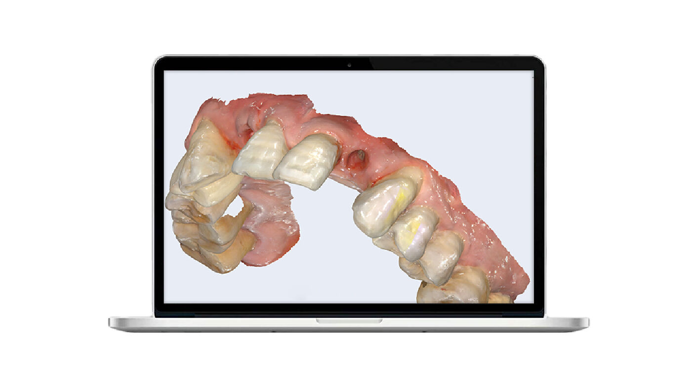 4d x ml  the ideal restoration choice in the digital dentistry era-1