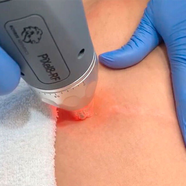 Boost collagen production for radiant skin with our innovative treatmen