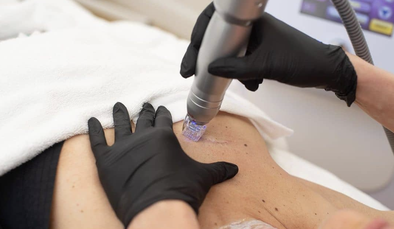 Rf Microneedling: The Rejuvenation Technology to Literally Turn Back Time for Your Neck