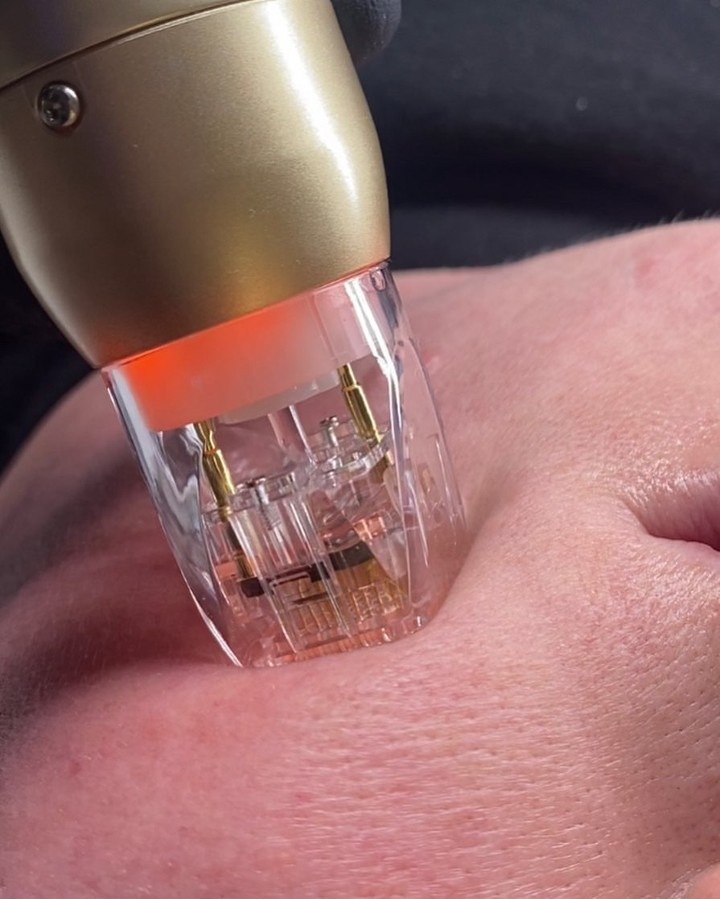 Vivace Microneedle-Gerät – Heben Sie Ihre Hautpflege auf die nächste Stufe