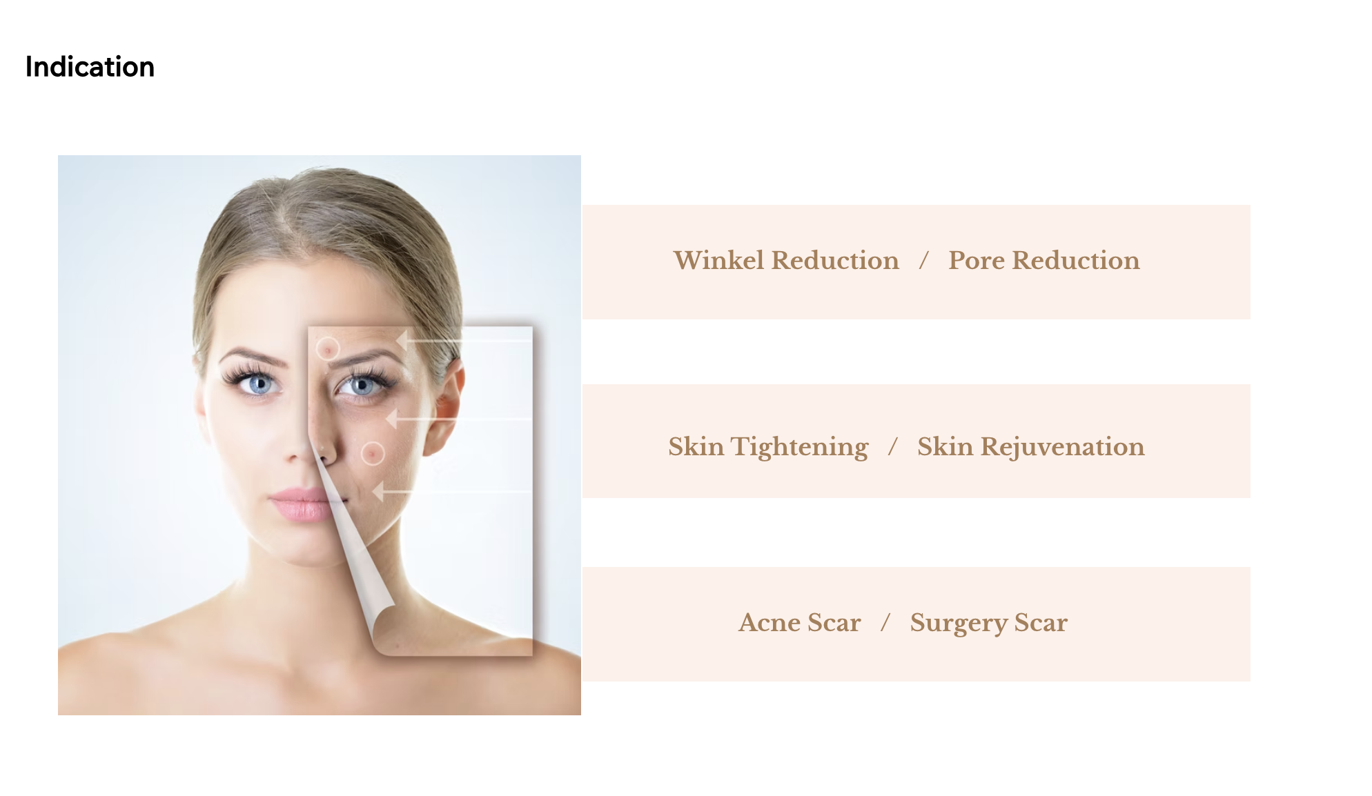 Fractional RF needling for enhanced skin texture and tone